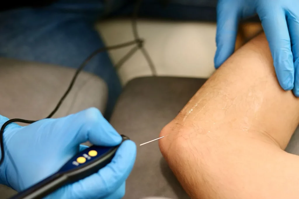 tratamiento codo epi tratamiento codo epi